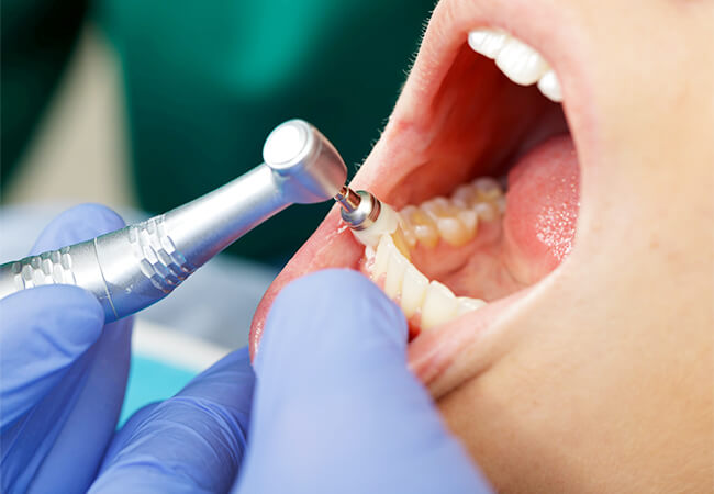 PMTC(Professional Mechanical Tooth Cleaning)