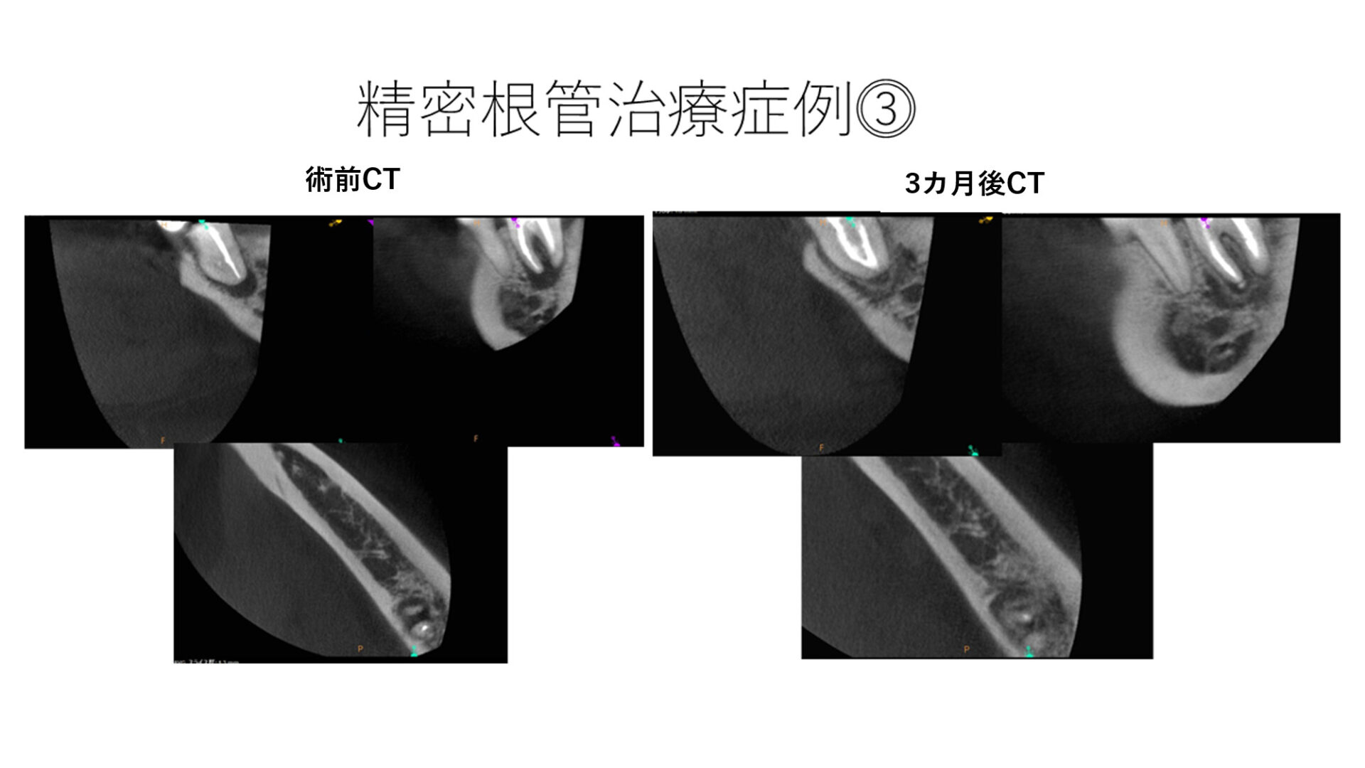 精密根管治療の症例③