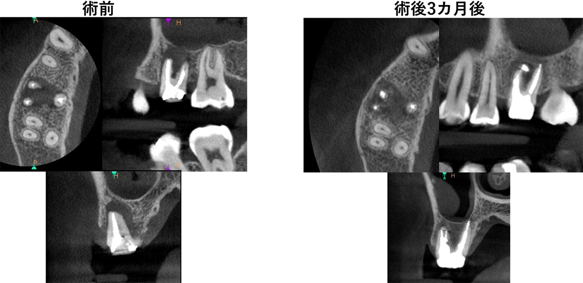 精密根管治療の症例①