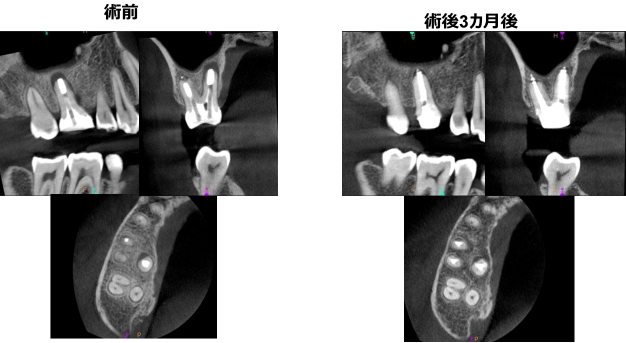 精密根管治療の症例②