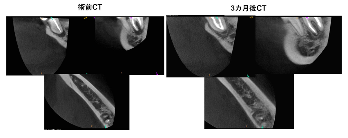 精密根管治療の症例③