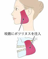 咬筋にボツリヌスを注入